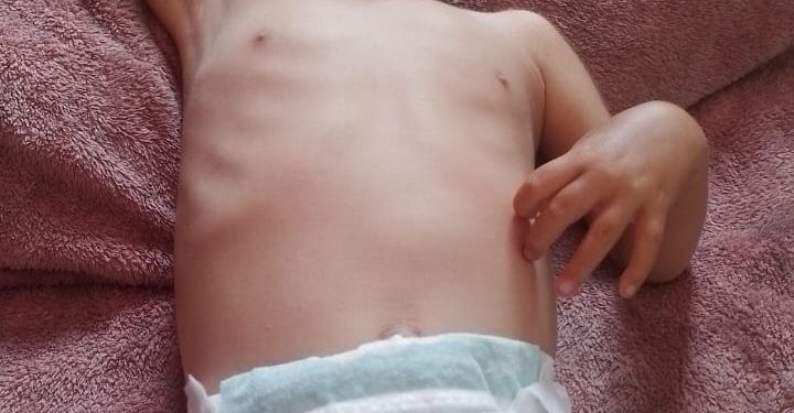 Malnutrisi di Cianjur, Balita Warga Cugenang Idap Gizi Buruk