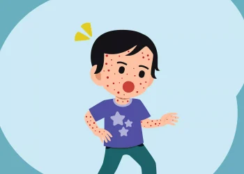 RSUD Sayang Imbau Masyarakat Cianjur Waspada Campak