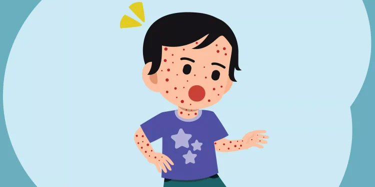 RSUD Sayang Imbau Masyarakat Cianjur Waspada Campak